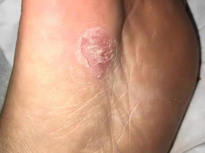 胼胝腳掌有個粗糙發紅的硬塊圖 胼胝腳掌有個粗糙發紅的硬塊圖