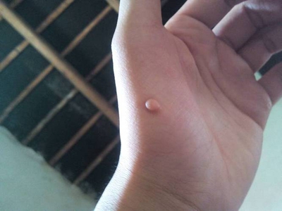 小汗腺汗孔瘤手掌上肉色疙瘩圖 小汗腺汗孔瘤手掌上肉色疙瘩圖