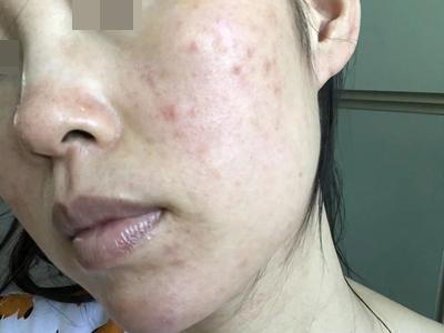 糖皮質激素性紅斑臉頰有紅色疹子圖