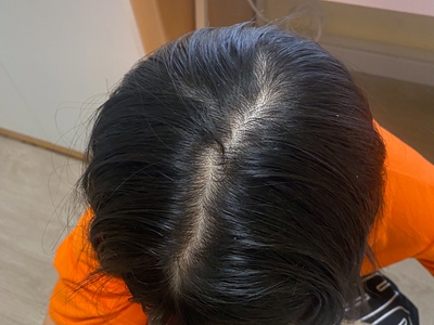 雄激素性脫髮頭髮減少發縫變寬圖 雄激素性脫髮頭髮減少發縫變寬圖