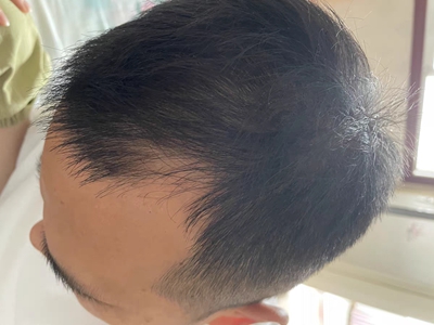 雄激素性脫髮前額角頭髮禿了一塊圖 雄激素性脫髮前額角頭髮禿了一塊圖