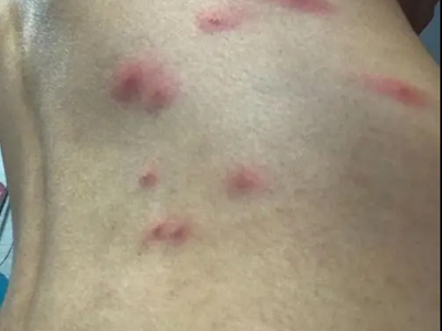 蠓蟲叮咬後背有紅色大片疙瘩圖