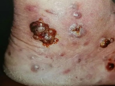 愛滋病皮膚腫瘤腳踝有紅色結節圖