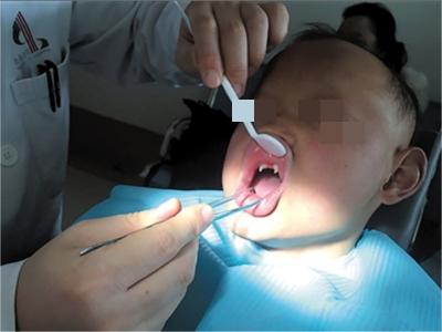 先天性胚葉發育不良牙齒缺損變形圖