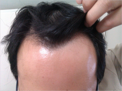 男性型脫髮髮際線呈M型後移圖