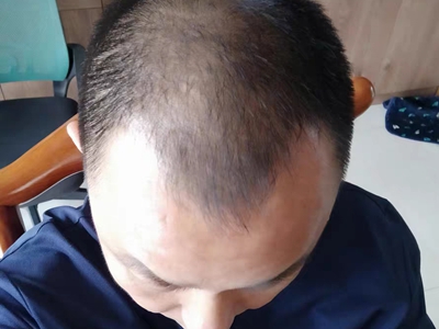 雄激素性脫髮額角禿了頭髮油膩圖 雄激素性脫髮額角禿了頭髮油膩圖