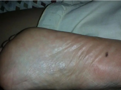 良性幼年黑素瘤腳底有一個黑痣圖 良性幼年黑素瘤腳底有一個黑痣圖