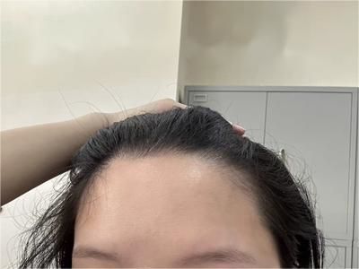 女性型脫髮前額髮際線處頭髮稀少圖 女性型脫髮前額髮際線處頭髮稀少圖
