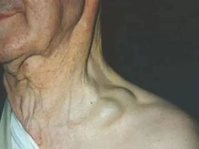 愛滋病皮膚腫瘤側頸部有兩個包塊圖 愛滋病皮膚腫瘤側頸部有兩個包塊圖