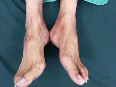 糖尿病性皮膚病腳背上有褐色斑點圖