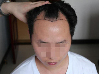 雄激素性脫髮額頭的頭髮禿了圖