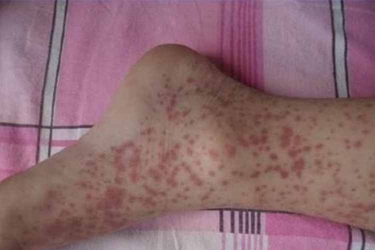 小兒過敏性紫癜腳踝有小紅斑圖 小兒過敏性紫癜腳踝有小紅斑圖