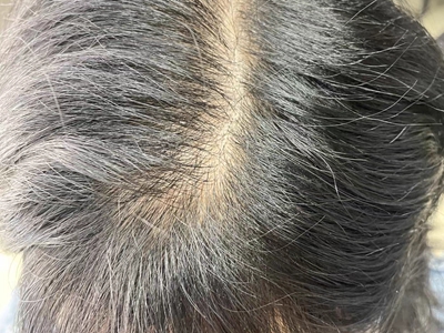 雄激素性脫髮發縫變寬毛髮稀疏圖