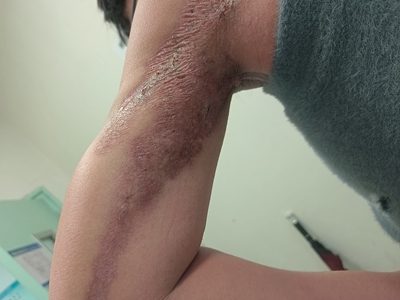 硬化萎縮性苔蘚胳膊上有大片瘢痕圖