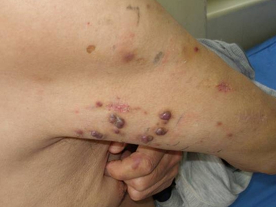 愛滋病皮膚腫瘤胳膊淡紫色結節圖 愛滋病皮膚腫瘤胳膊淡紫色結節圖