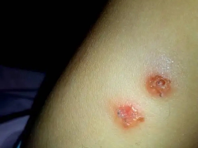 皰疹樣膿皰病大腿出現潰瘍圖 皰疹樣膿皰病大腿出現潰瘍圖