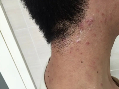 嗜酸性膿皰性毛囊炎側頸紅色丘疹圖 嗜酸性膿皰性毛囊炎側頸紅色丘疹圖