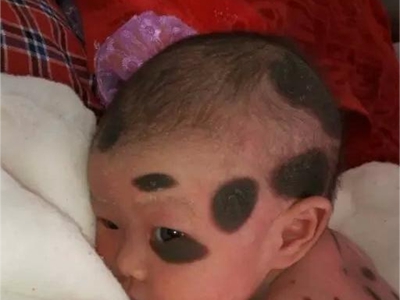 獸皮痣頭部有好幾塊雞蛋形狀的黑斑圖