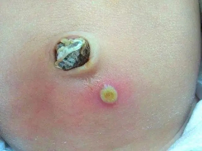 新生兒膿皰瘡肚臍周圍出現黃色膿包圖 新生兒膿皰瘡肚臍周圍出現黃色膿包圖
