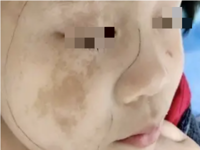 咖啡斑臉上有不規則的淺棕色斑圖 咖啡斑臉上有不規則的淺棕色斑圖
