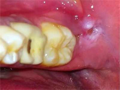 三期口腔梅毒牙齦裡面有白色潰瘍圖 三期口腔梅毒牙齦裡面有白色潰瘍圖