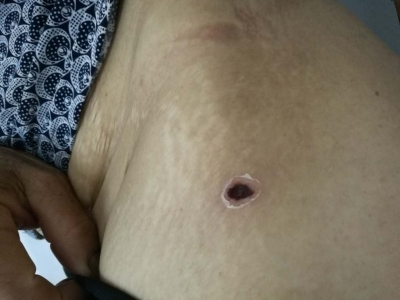 恙蟲病腰外側有一個不規則黑焦痂圖