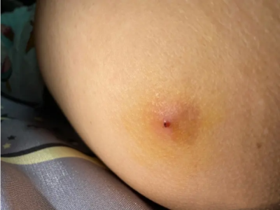 皮脂腺囊腫肚子上長疙瘩圖 皮脂腺囊腫肚子上長疙瘩圖