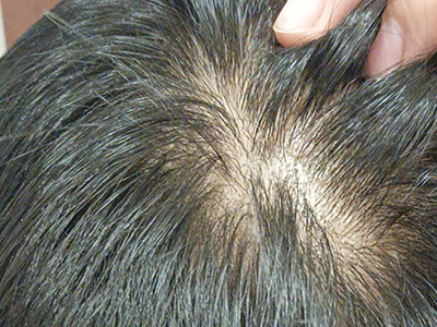 男性型脫髮頭頂頭髮很稀疏圖 男性型脫髮頭頂頭髮很稀疏圖