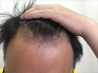 男性型脫髮額頭髮際線後移圖 男性型脫髮額頭髮際線後移圖
