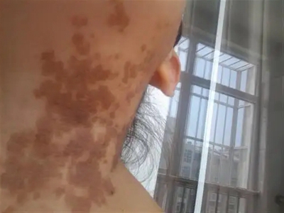 咖啡斑脖子上有多個深棕色斑圖