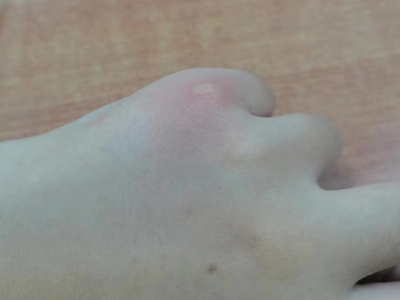 蚊子叮咬手背上起了個小疙瘩圖