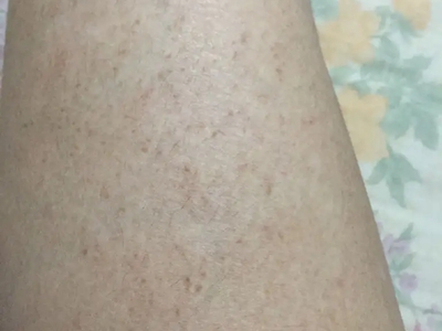 網狀肢端色素沉著大腿有好多斑點圖 網狀肢端色素沉著大腿有好多斑點圖