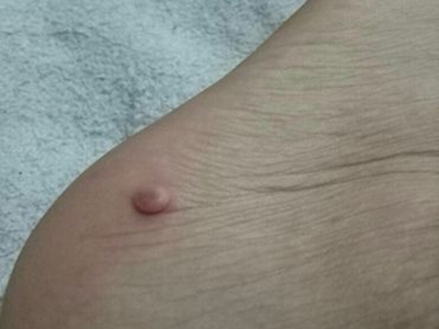 小汗腺汗孔瘤腳後跟有一個小紅疙瘩圖 小汗腺汗孔瘤腳後跟有一個小紅疙瘩圖