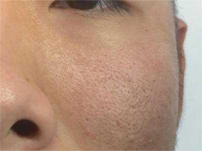 黑頭面頰毛孔大好多黑點影響美觀圖 黑頭面頰毛孔大好多黑點影響美觀圖