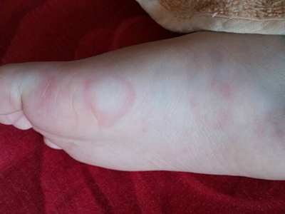 幼年跖部皮病腳底一側有紅斑圖 幼年跖部皮病腳底一側有紅斑圖