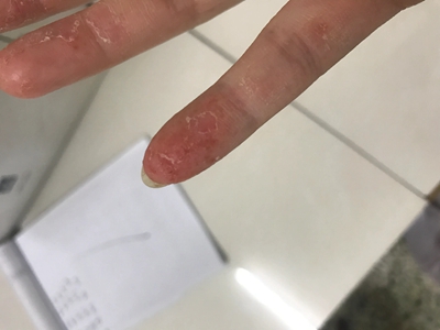 皰疹樣膿皰病手指指端脫皮圖 皰疹樣膿皰病手指指端脫皮圖