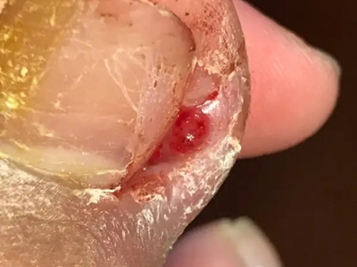 嵌甲大腳趾甲發黃邊緣腫脹流血圖 嵌甲大腳趾甲發黃邊緣腫脹流血圖