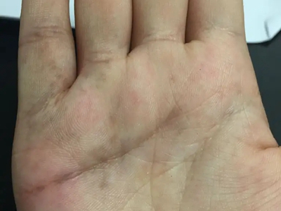 網狀肢端色素沉著手掌長褐色斑點圖 網狀肢端色素沉著手掌長褐色斑點圖