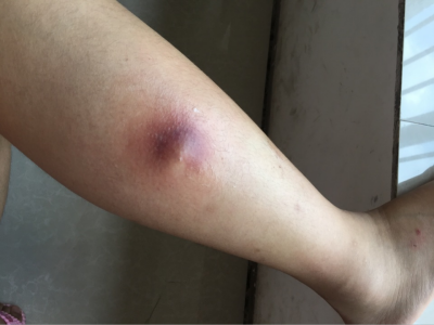 皮脂腺囊腫小腿長紅紫色大疙瘩圖