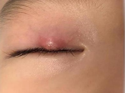 皮脂腺上皮瘤上眼瞼長疙瘩圖 皮脂腺上皮瘤上眼瞼長疙瘩圖