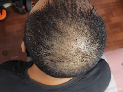 雄激素性脫髮頭頂處頭髮減少圖 雄激素性脫髮頭頂處頭髮減少圖