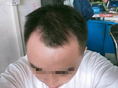 雄激素性脫髮髮際線後移額頭寬大圖 雄激素性脫髮髮際線後移額頭寬大圖