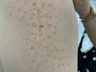 血管內壓力增多性紫癜背部長紅斑圖