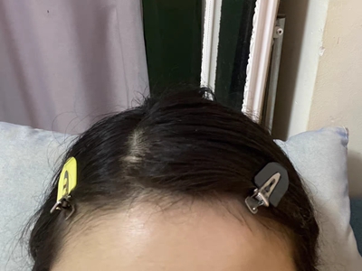 女性型脫髮頭上發縫明顯圖