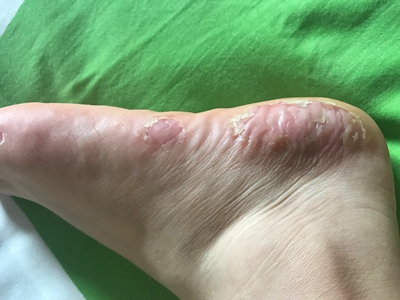 皰疹樣膿皰病腳後跟脫皮圖