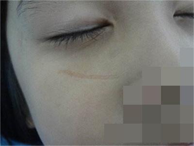 萎縮性瘢痕面部一條凹下去的瘢痕圖