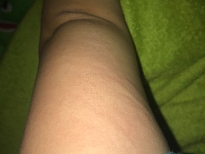 海鮮過敏大腿上長條形風團圖
