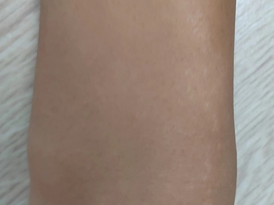 線狀苔蘚胳膊上長疹子連成一條線圖 線狀苔蘚胳膊上長疹子連成一條線圖