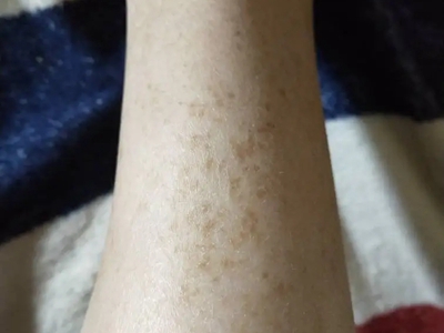 網狀肢端色素沉著小腿有好多褐色斑圖 網狀肢端色素沉著小腿有好多褐色斑圖