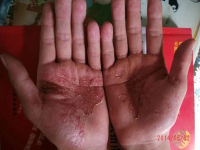 局限性膿皰型銀屑病手掌發紅起皮圖